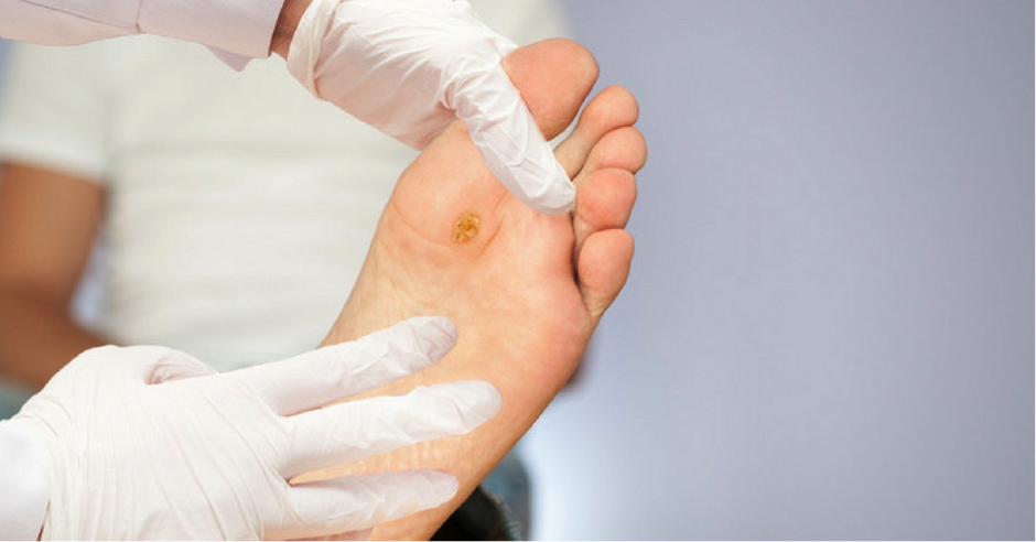 Warts and Fungal Skin Infection