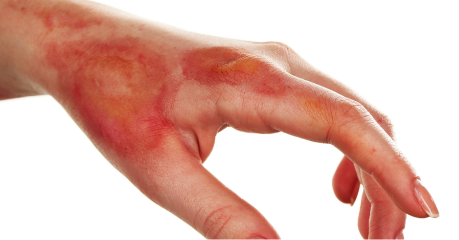 Eczema causes