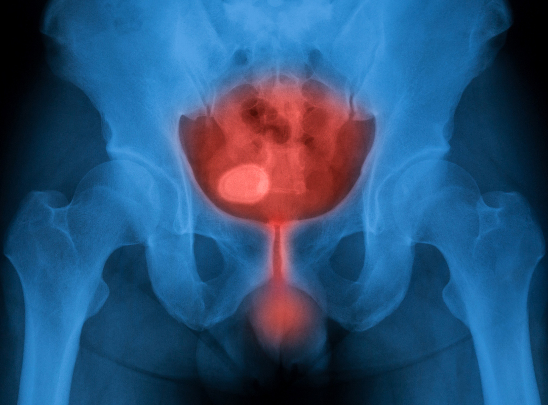 X-ray image of bladder,