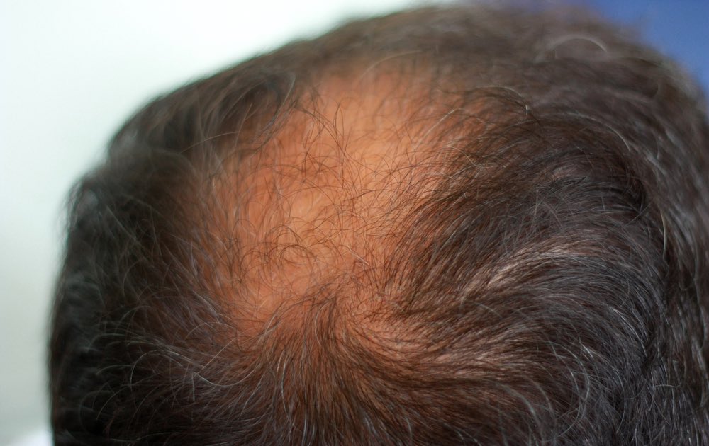Male head with hair loss symptoms back side