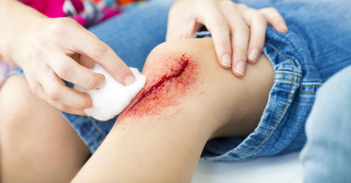 Caring For Minor Laceration Wounds 